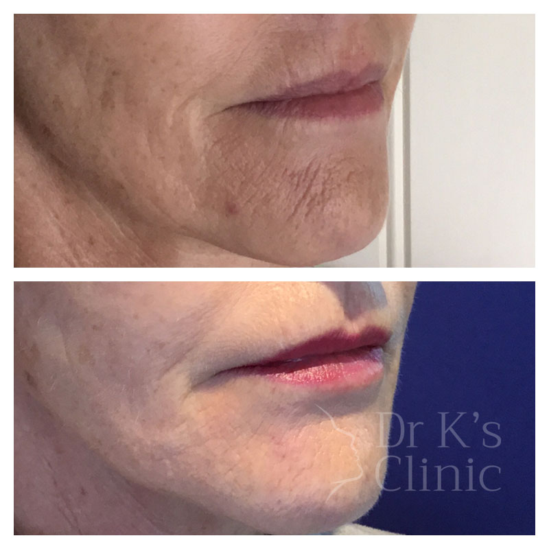 Medical Microneedling & Mesotherapy In Chester & Wrexham